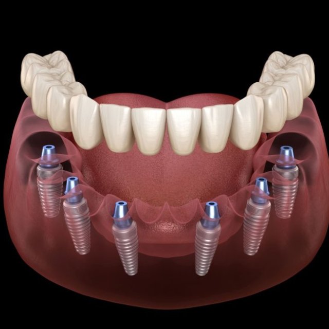 Smart Arches Dental Implants - New York City